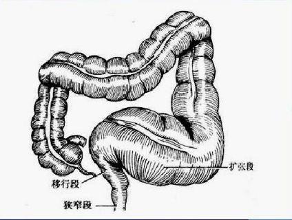 直肠肛管先天性疾病