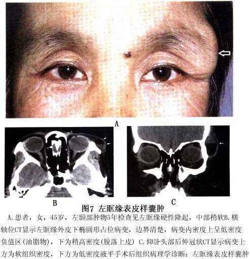 眼眶皮样囊肿