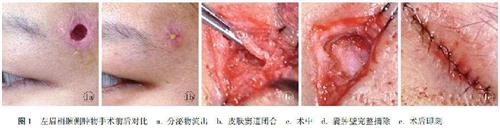眼眶皮样囊肿