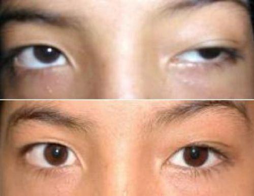 眼睑闭合不全