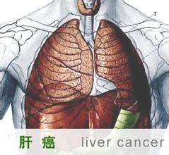 继发性肝癌