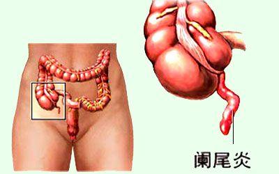 老年急性阑尾炎