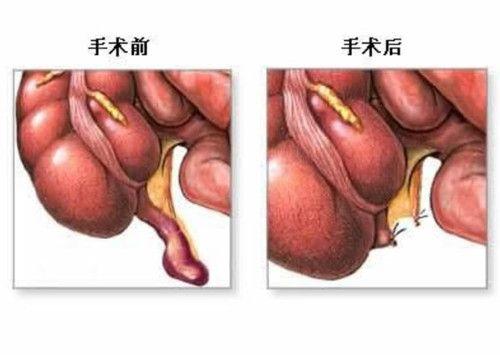 老年急性阑尾炎