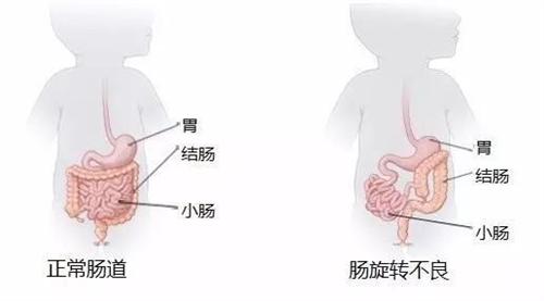 肠扭转