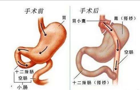 胃切除术后并发症