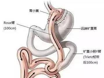 胃切除术后并发症
