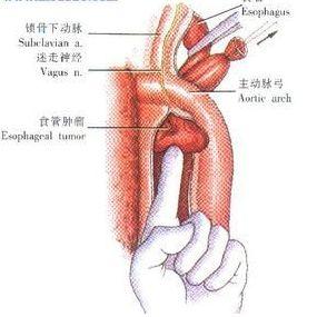 胃切除术后并发症