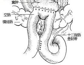 胰腺假性囊肿