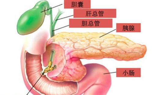 胰腺结石