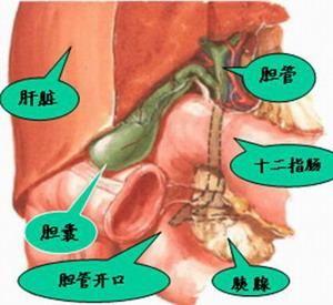 胰腺结石