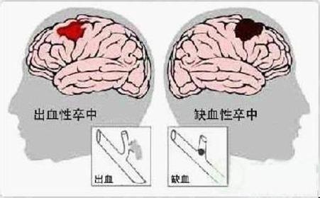血管性血友病