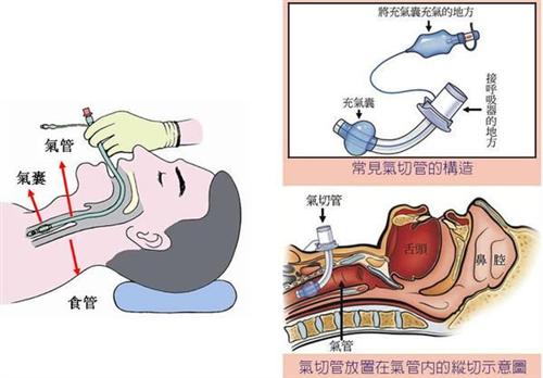 食管气管瘘