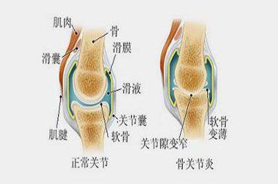 骨炎