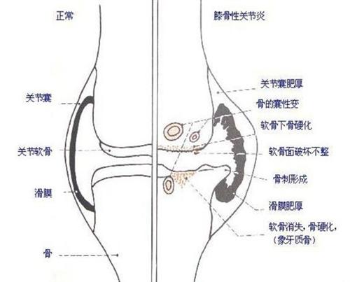 骨炎