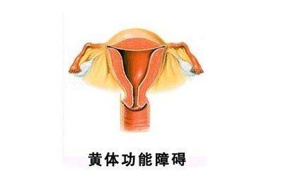 黄体功能不全性不孕