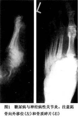 先天性感觉性神经病