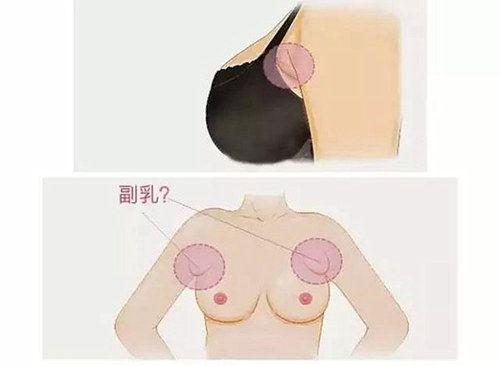 副乳乳腺癌