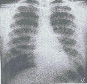 发热伴出血