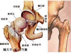 外伤性股骨头坏死