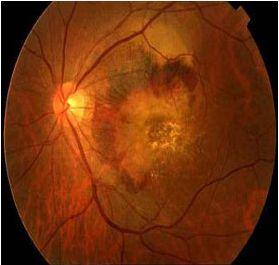 珠蛋白生成障碍性贫血视网膜病变