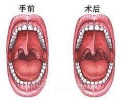 白血病性咽峡炎