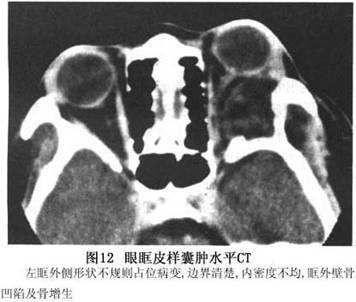 眼眶皮样囊肿