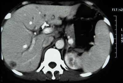 腹膜后感染与脓肿