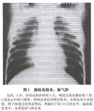 腺病毒肺炎