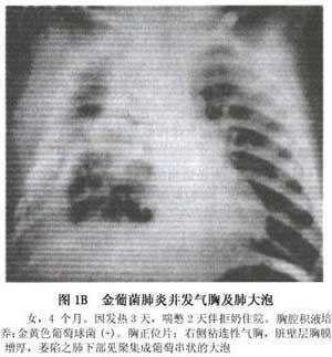 葡萄球菌肺炎