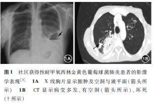 葡萄球菌肺炎