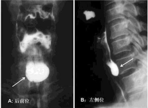 食管瘢痕性狭窄
