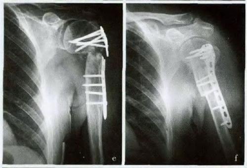 骨折不愈合