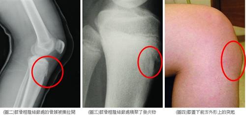 骨炎