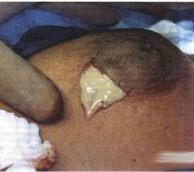 急性化脓性乳腺炎