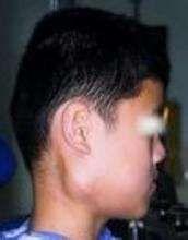 慢性化脓性腮腺炎