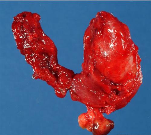 甲状腺微小癌