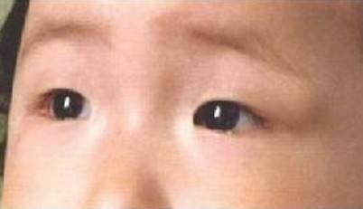眼眶皮样囊肿