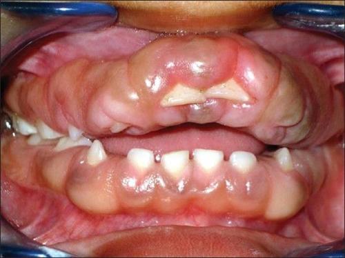 药物性牙龈增生