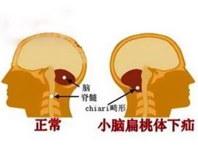 小脑畸形