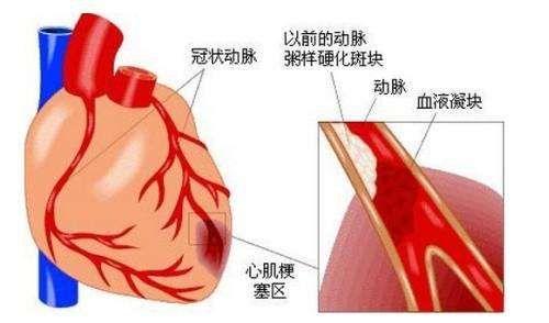 心脏排血受阻