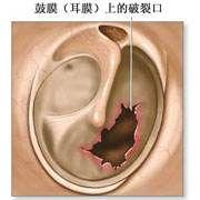 耳鼓膜破裂