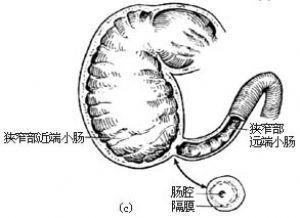 肠闭锁