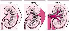 肾脏破裂