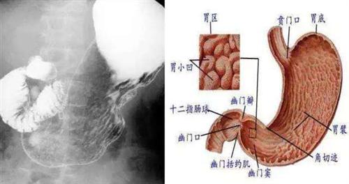 胃粘膜脱垂图片