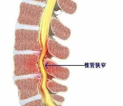 腰椎椎管狭窄