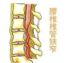 腰椎椎管狭窄
