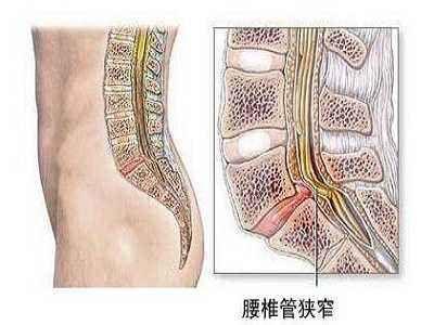 腰椎椎管狭窄