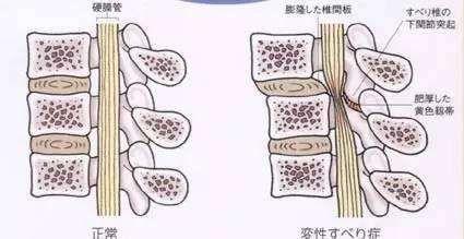 腰椎椎管狭窄