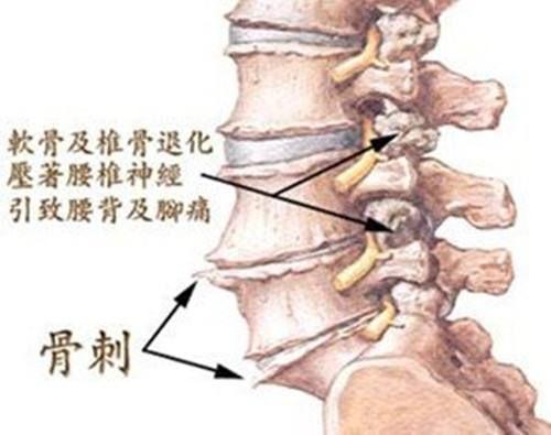 腰椎退化