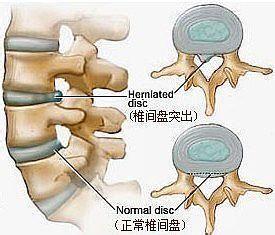 腰椎退化